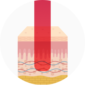 기존 피부를 깎는 박피